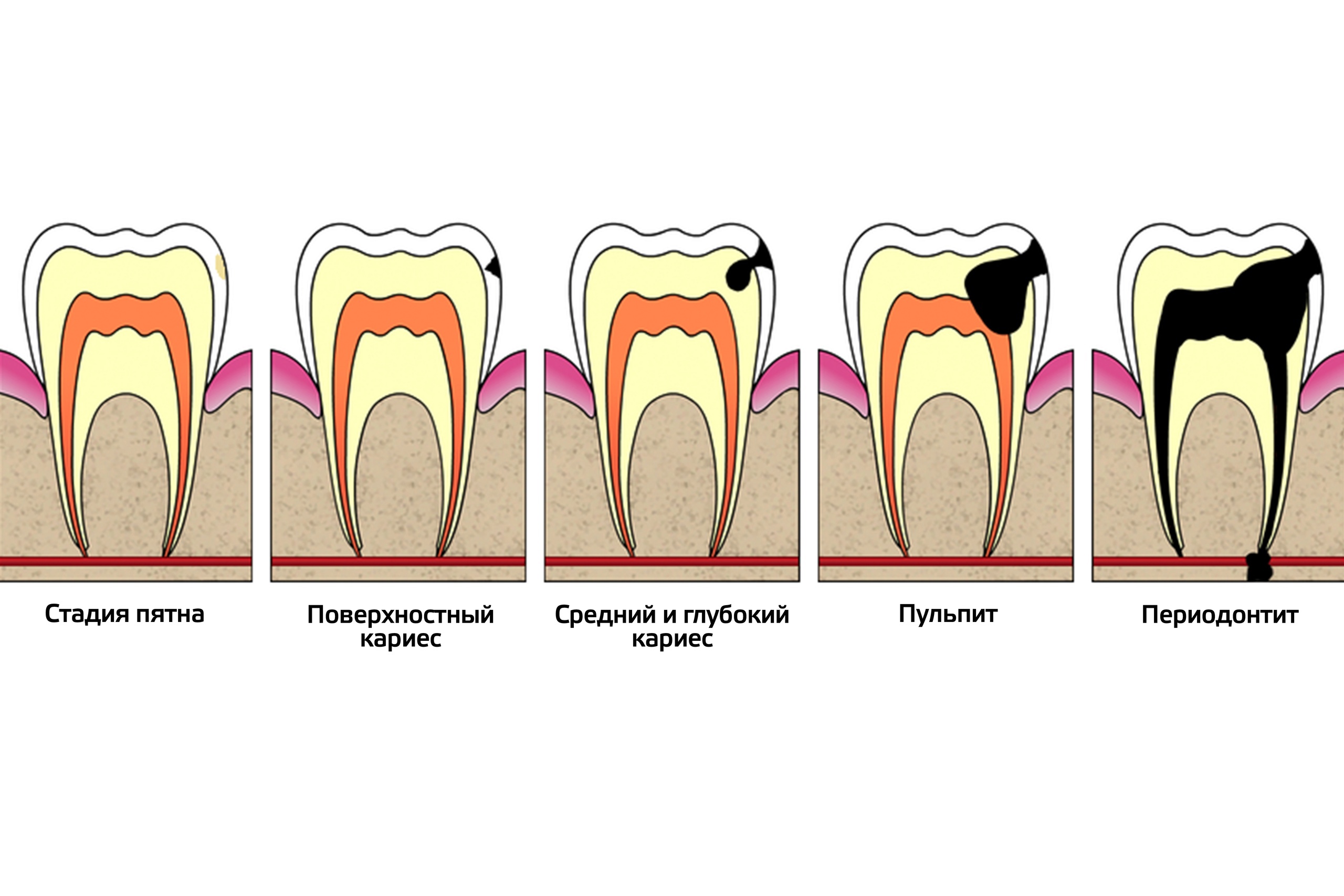 Распространённые болезни зубов