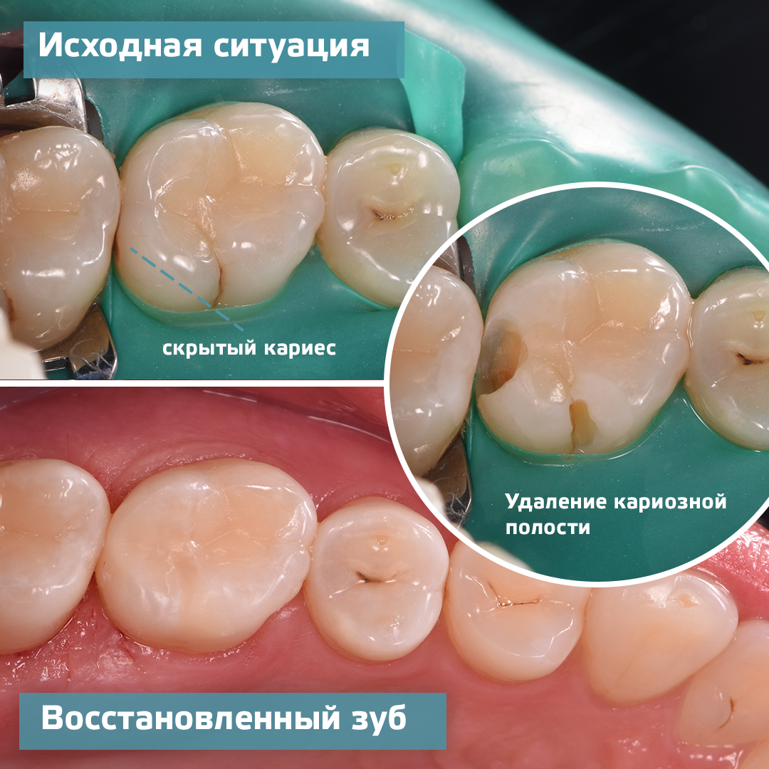 Восстановление зуба фото