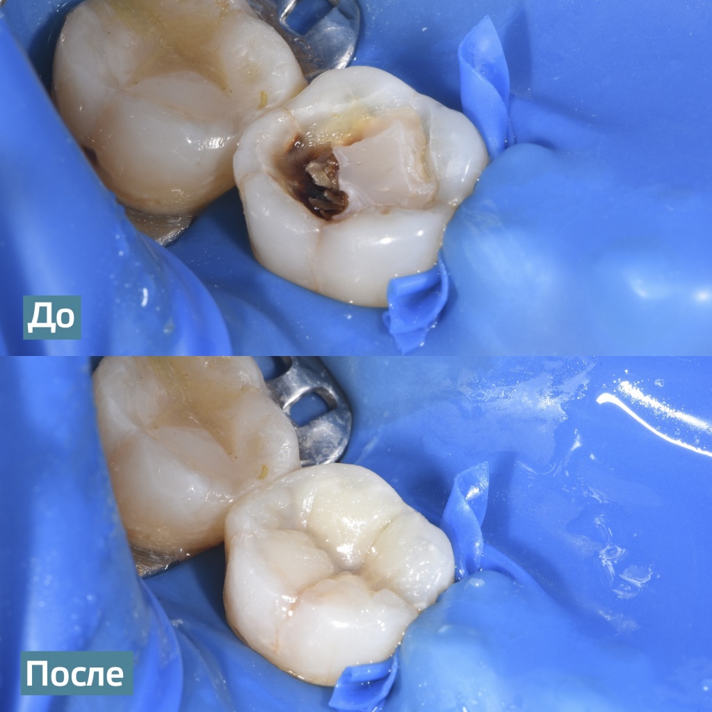 Протезирование зубов в Твери 🦷 цены | Дента-Люкс